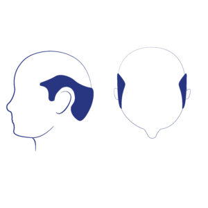 Phase 7 - C’est la forme de perte de cheveux la plus avancée ou la plus sévère. Il reste seulement une étroite bande de cheveux sur les côtés et à l’arrière de la tête sous forme de fer à cheval. Ces cheveux peuvent être plus minces et moins denses qu’auparavant. Les cheveux sur les deux oreilles sont clairsemés sous forme semi-circulaire.